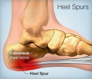 Formation of a bone spur under the heel
