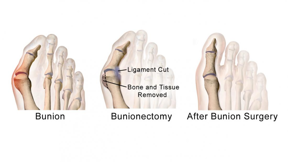 7 Exercises Great for Relieving Bunion Pain