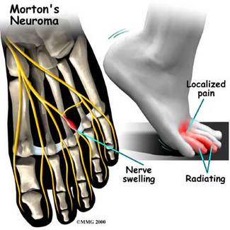 Can Sciatica Cause Foot Pain and Swelling?