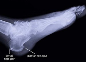 Bone spurs on x-ray