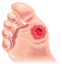 A foot ulcer is an open wound that poorly heals