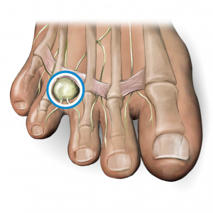 A neuroma is a thickening of nerve tissue
