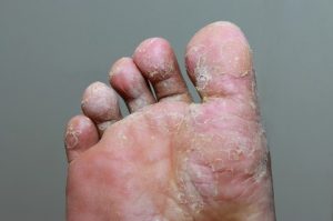 Athlete's foot can spread
