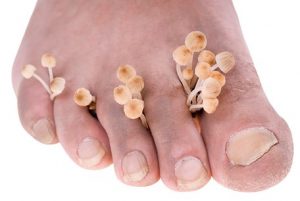 Athlete's foot is caused by fungus