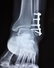 Broken foot bone on x-ray