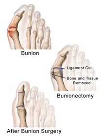 Bunion removal surgery