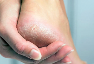Callus formation on the heel