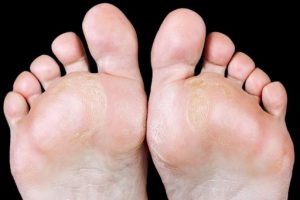 Callus formation on the soles of feet