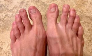 Chemotherapy effect on toenails