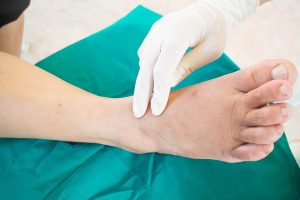 Complications of diabetes can lead to foot ulcers