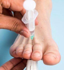 Cortisone injection for neuroma