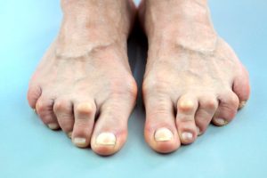 Hammertoe deformity