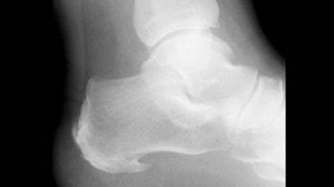 Heel spur as seen on x-ray