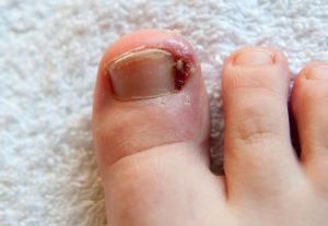 Infected ingrown toenail