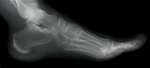 Lateral foot x-ray