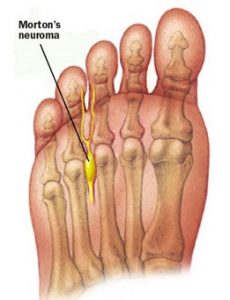 Neuroma between 3rd and 4th toes