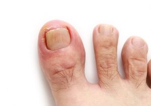 Pedicures might result in ingrown toenails