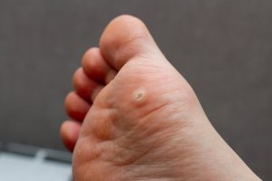 Wart on the bottom of the foot