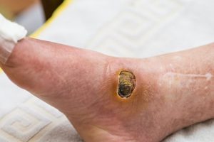 Poorly-healing wound