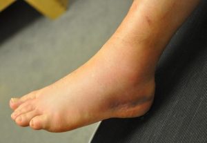 Swelling due to ankle sprain