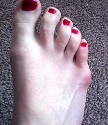 Tailor's bunion