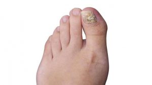 Toenail fungus can be treated in a number of ways