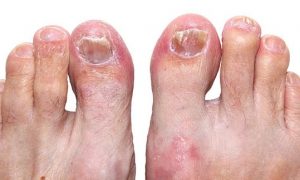 Toenail fungus can be unsightly