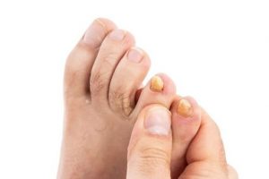 Topical medication needs to get beneath the nail
