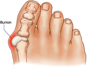 What the bunion joint looks like