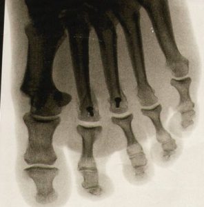 X-ray of the foot