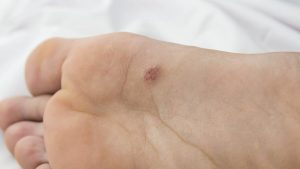 Wart on the sole of foot