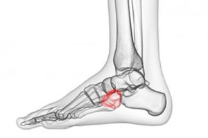 The cuboid bone of the foot