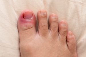 A red, swollen toe might mean you have an ingrown toenail