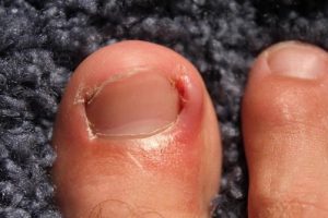 Ingrown toenails are a common problem