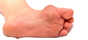 If you put off seeing your podiatrist for too long, you can be left with this foot problem!