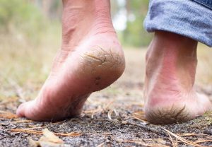 Here are some tips to get rid of cracked heels.