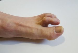 If hammertoes result in corns, you must treat them to prevent corns from recurring.