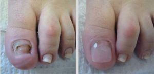 Before and after with Keryflex nail.