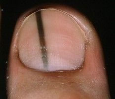 Melanoma in toenail often presents as brown or black streaks without any known injury.
