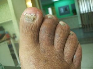 Onychomycosis is a fungal nail infection that discolors, thickens, and separates from the nail bed.