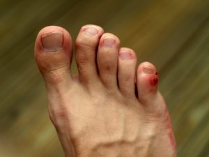 A stubbed toe is simply a toe that has been hit hard and may show signs of swelling or bruising.