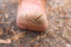Dryness is the main cause of cracked bottom of foot.