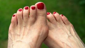 A bunion is a painful bony bump that develops on the inside of the foot at the big toe joint.