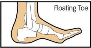 A floating toe as a toe that was not in complete contact with the floor under weightbearing conditions.