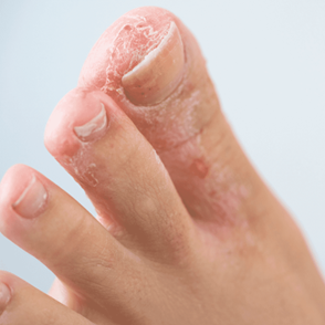 Athlete's foot can be a chronic infection that recurs frequently.
