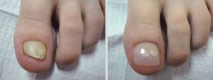 Before and after Keryflex Nail Restoration.