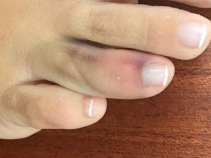 Swelling and bruising can be symptoms of a sprained toe.
