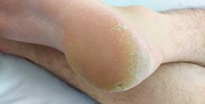 Dry and peeling skin on the soles of your feet can lead to discomfort and even pain.