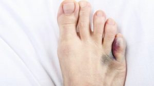 Jammed toes result from accidental impact or compression, causing pain, swelling, and limited movement.