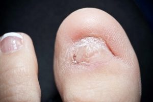 KeryFlex restores the appearance and protection of toes with missing nails.